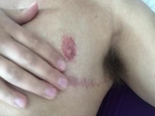 Masaje de cicatrices en el pecho FtM